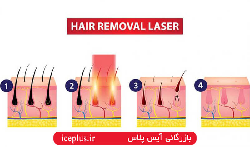 How-does-diode-laser-hair-removal-work-