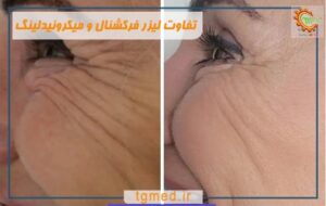 تفاوت لیزر فرکشنال و میکرونیدلینگ + راهنمای جامع